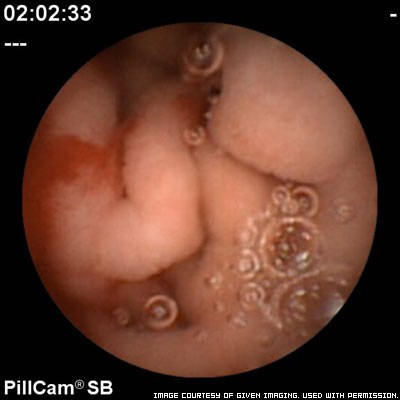 Pill-Cam-Images-788