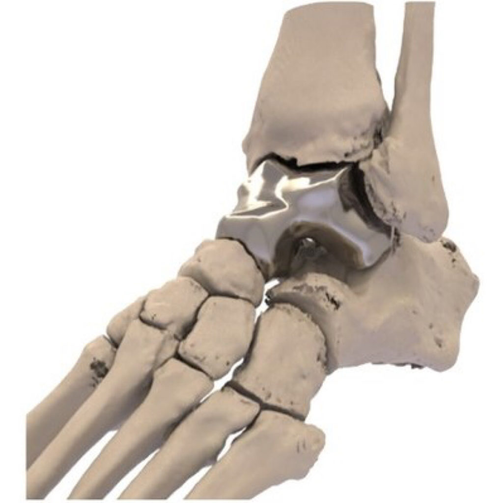 Additive Orthopaedics Gains FDA Approval for First 3D Printed Talus Implant Impact Lab