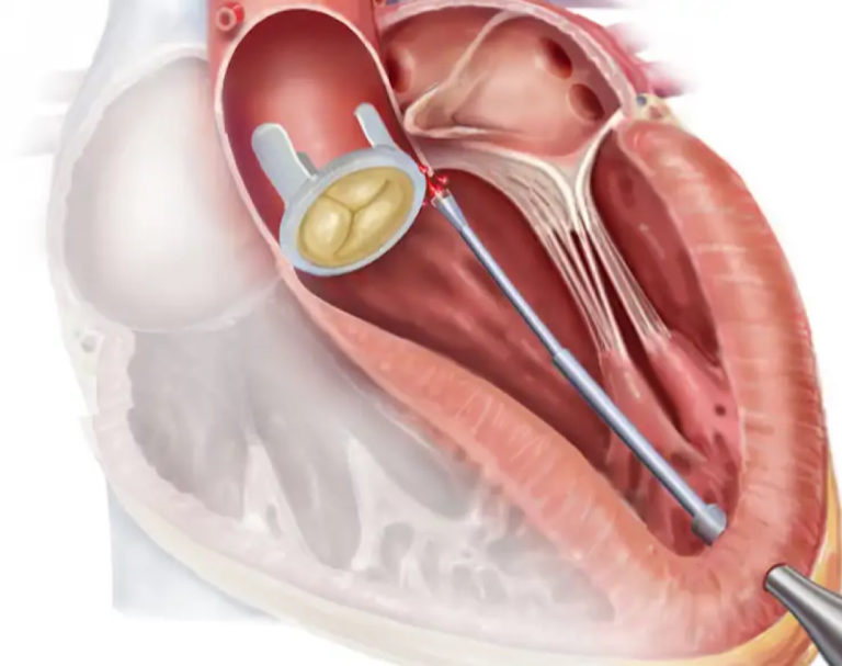 Surgeons Use Self Navigating Robot To Find Leaky Valve In Pig Hearts