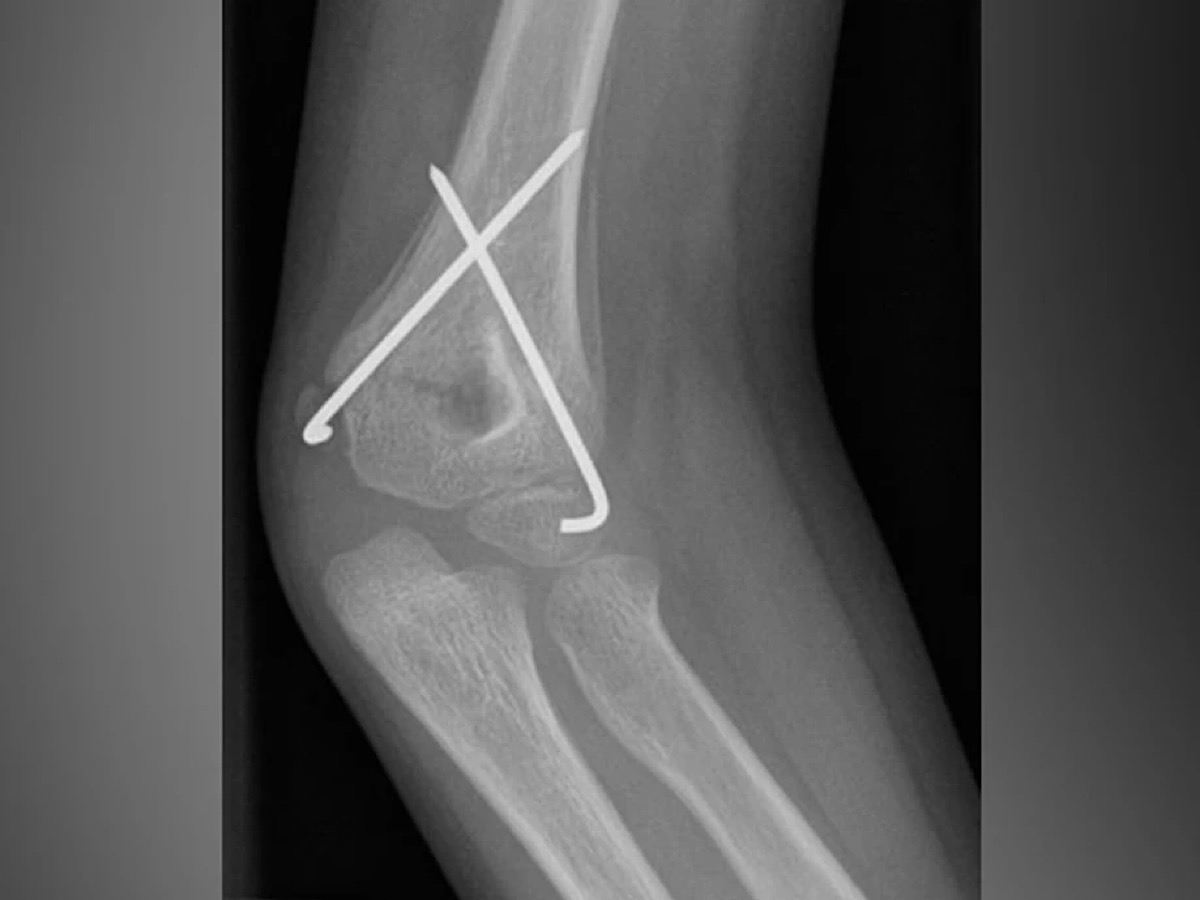 Researchers develop bone growth inspired ‘microrobots’ that can create their own bone