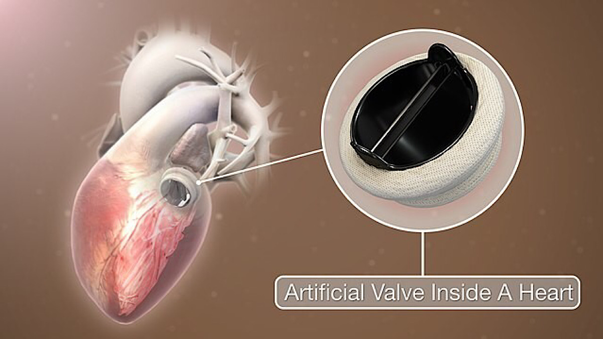 Artificial Heart: Researchers Use Focused Rotary Jet Spinning Technology for More Advanced Human Transplant